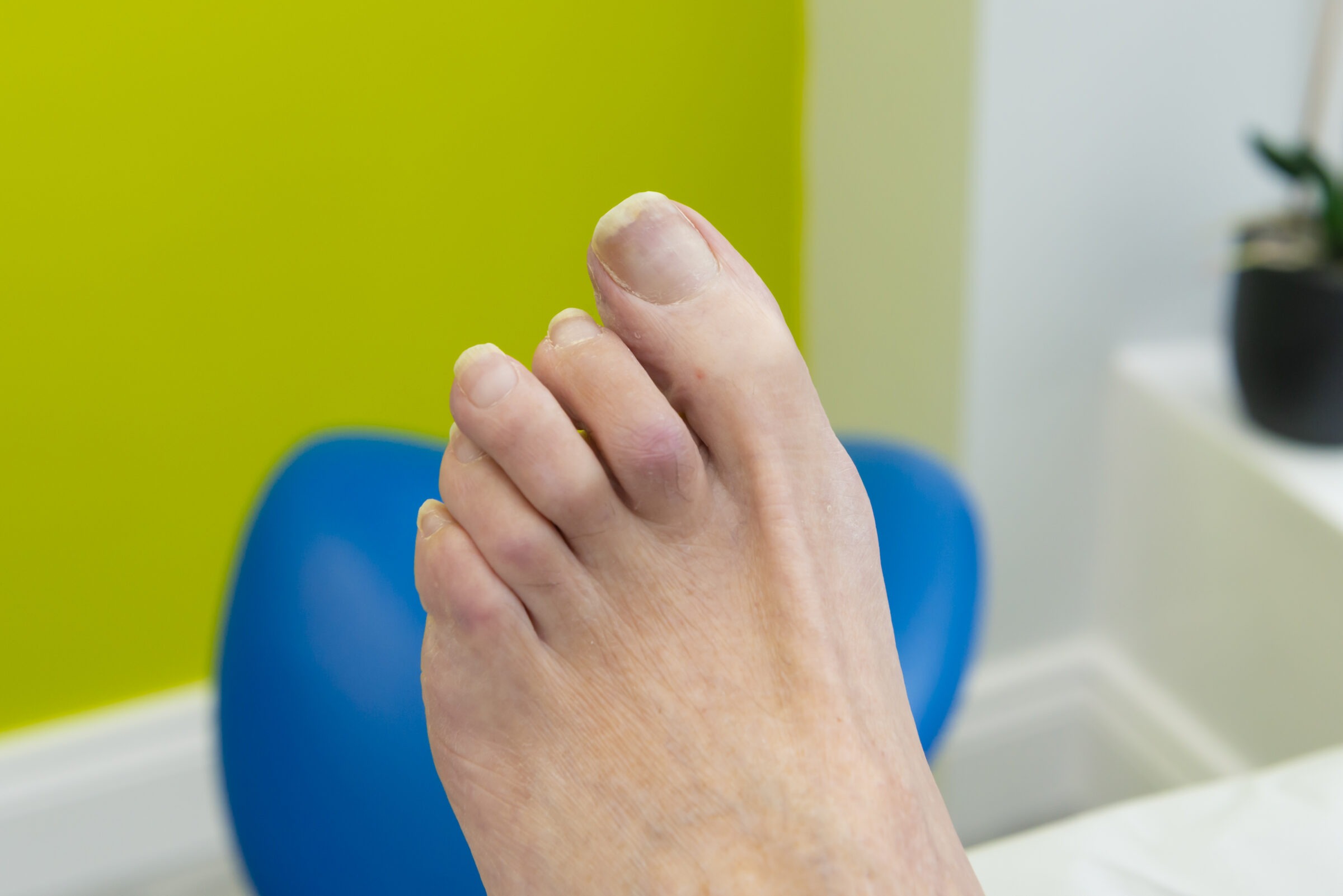 Fungal Nail Treatment Dublin