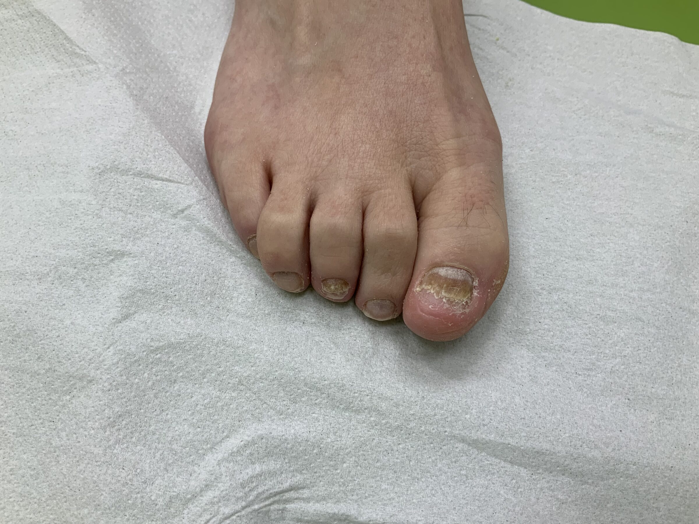 Nail Recon Before (A)