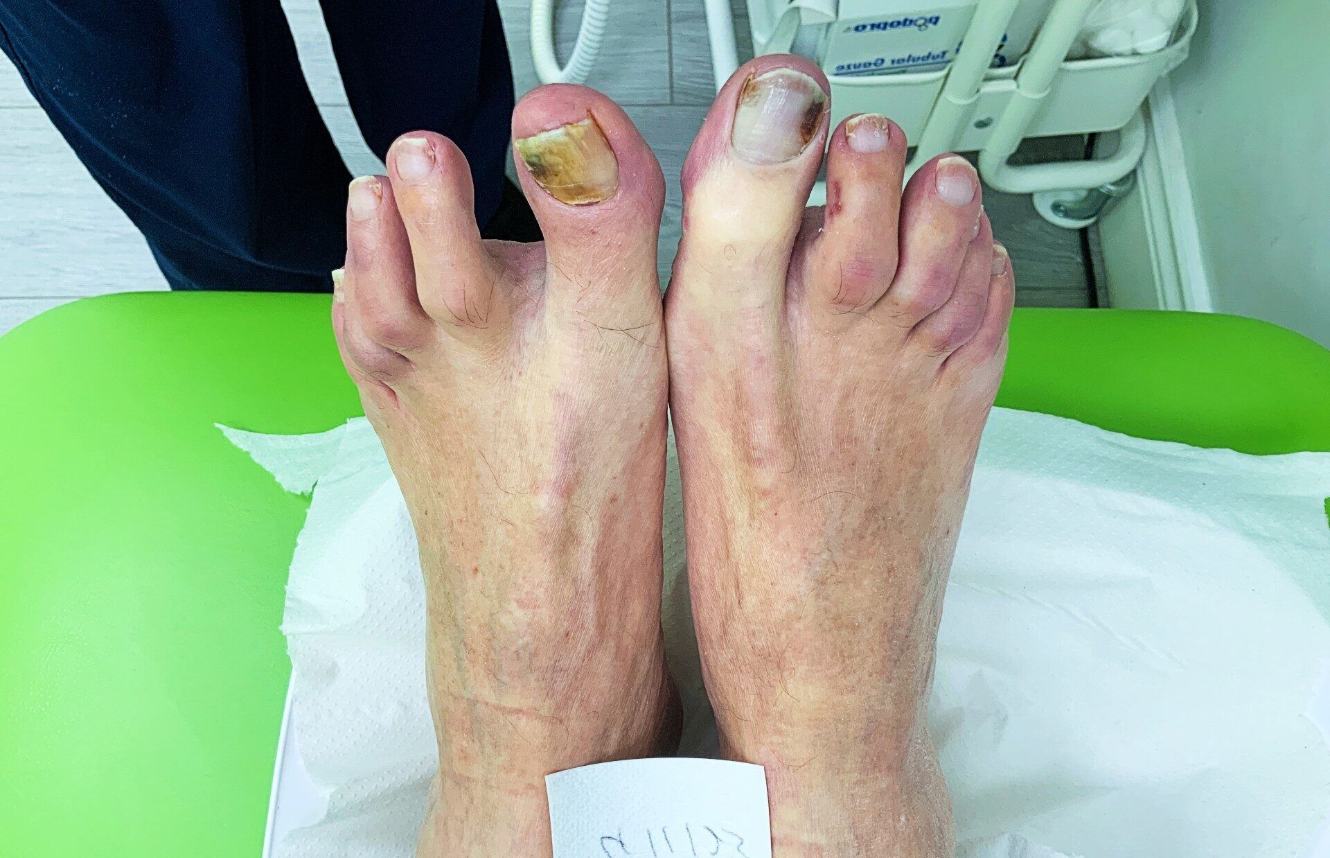 fungal nail 1 (before)